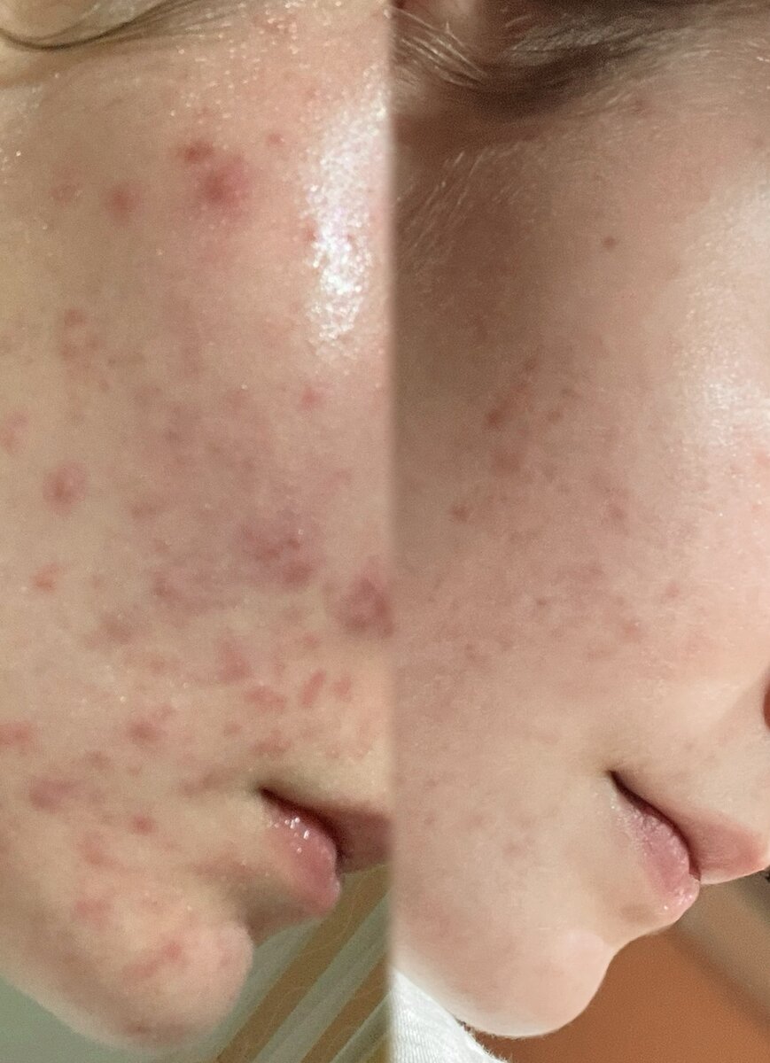 Acne treatment before and after - clear skin transformation
