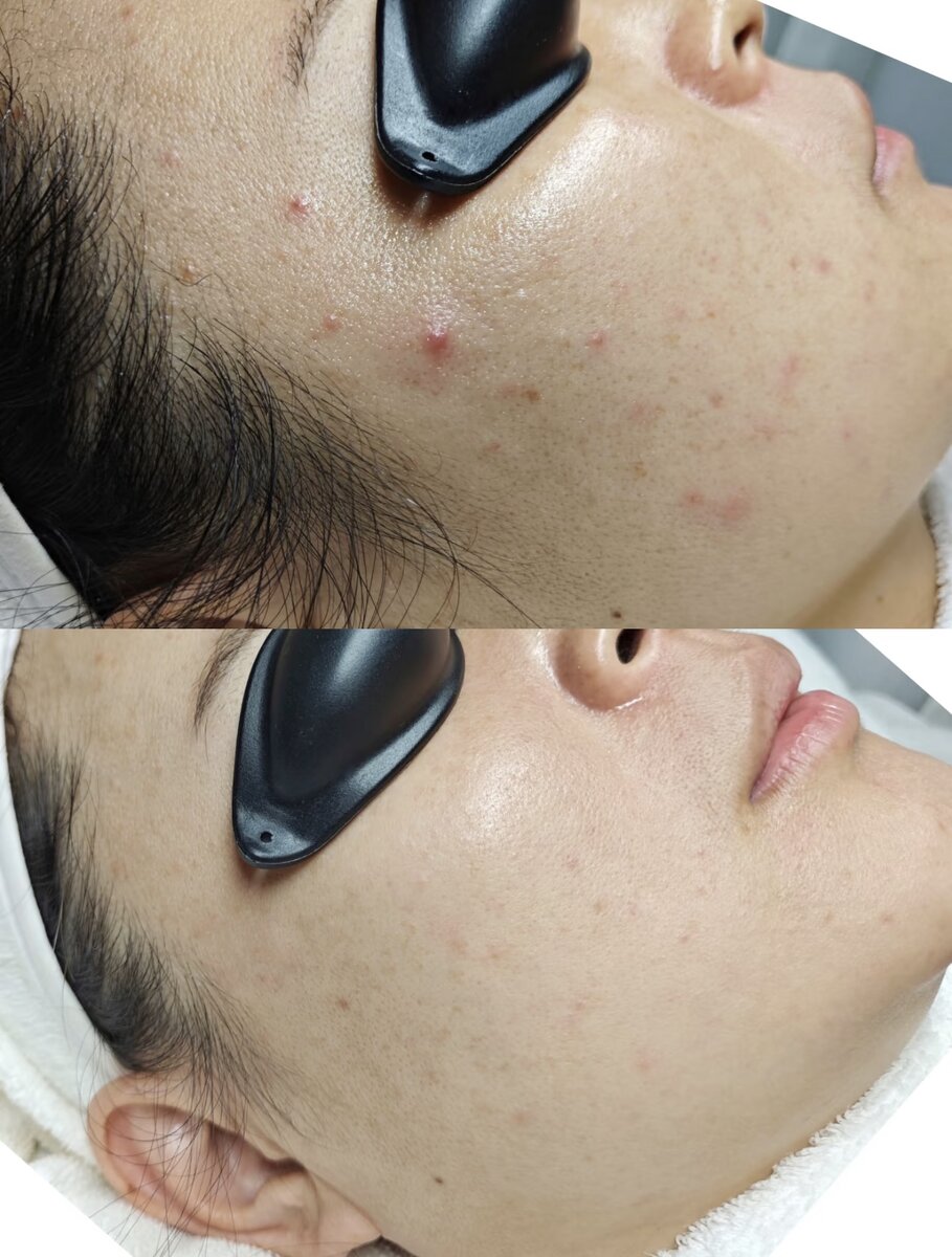Acne scar and pigmentation improvement