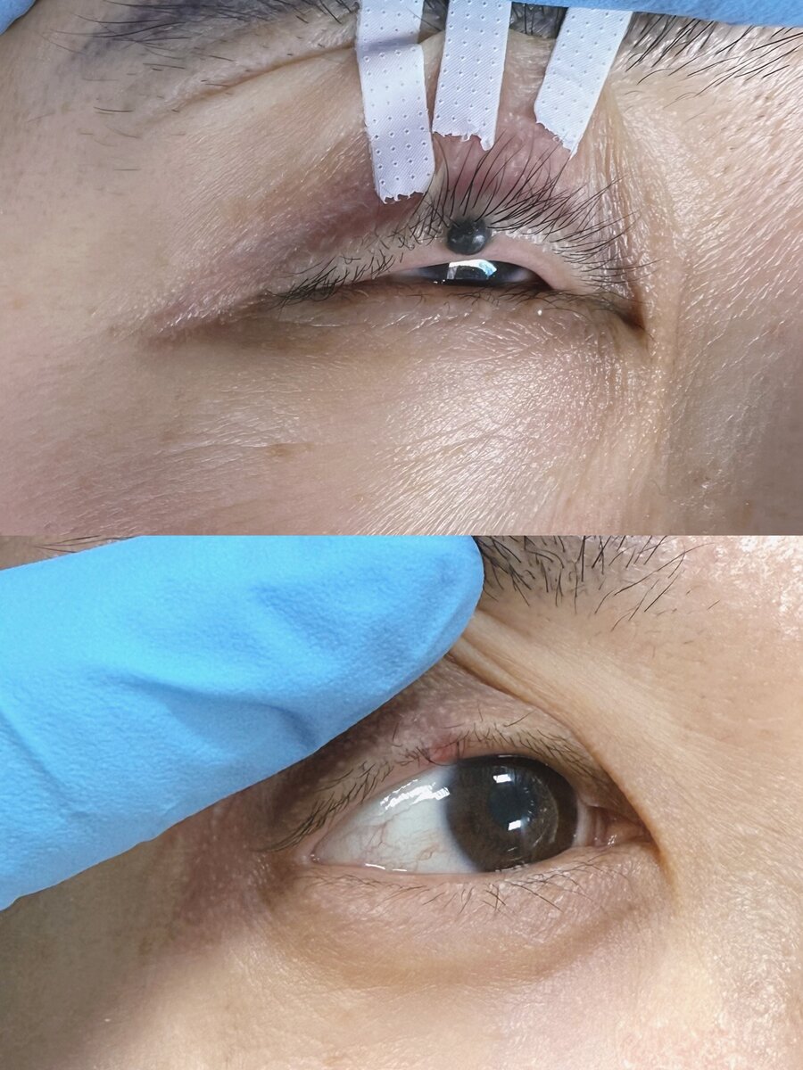Expert wart and mole removal