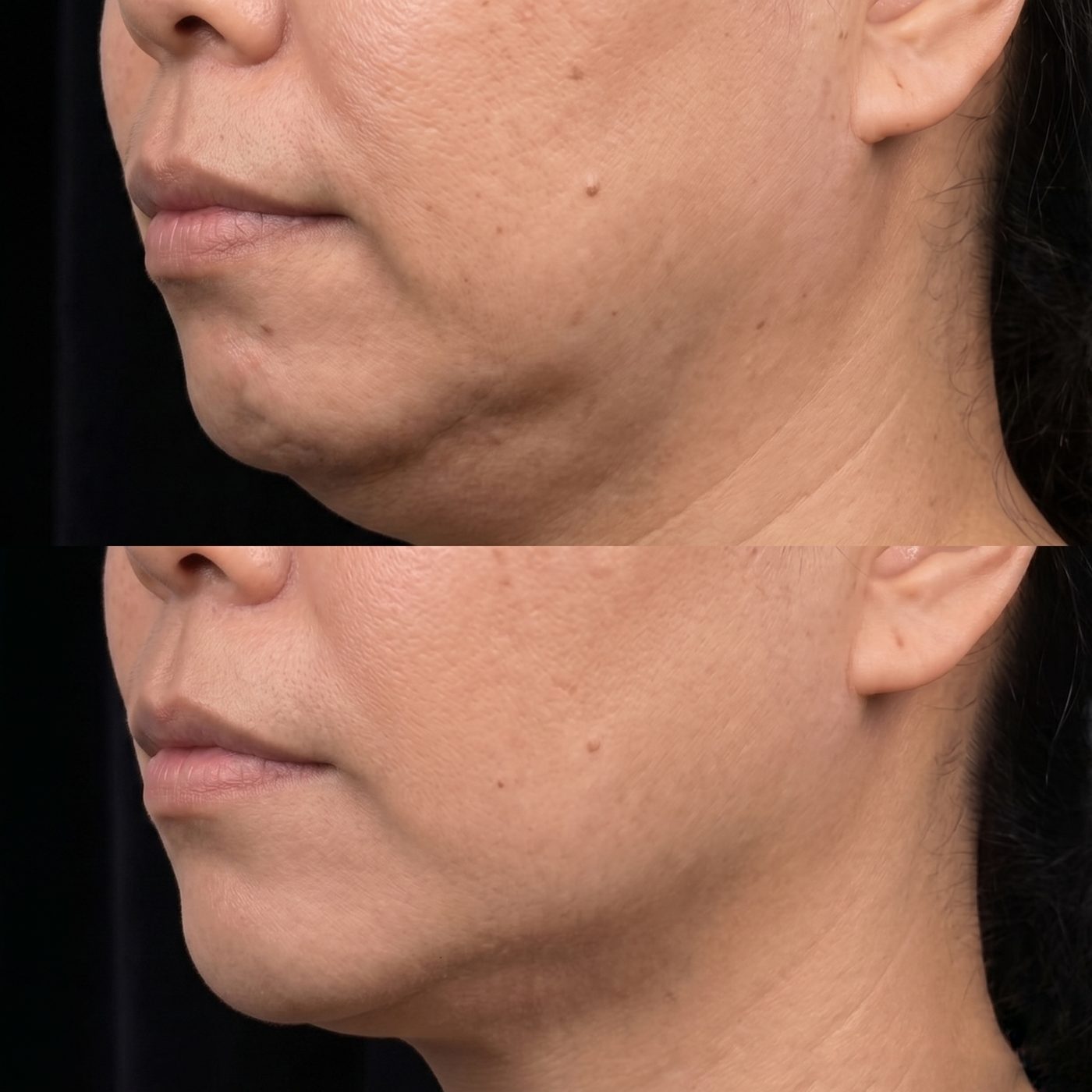Thermage FLX real client before and after jawline and neck tightening at NB&CO. Melbourne