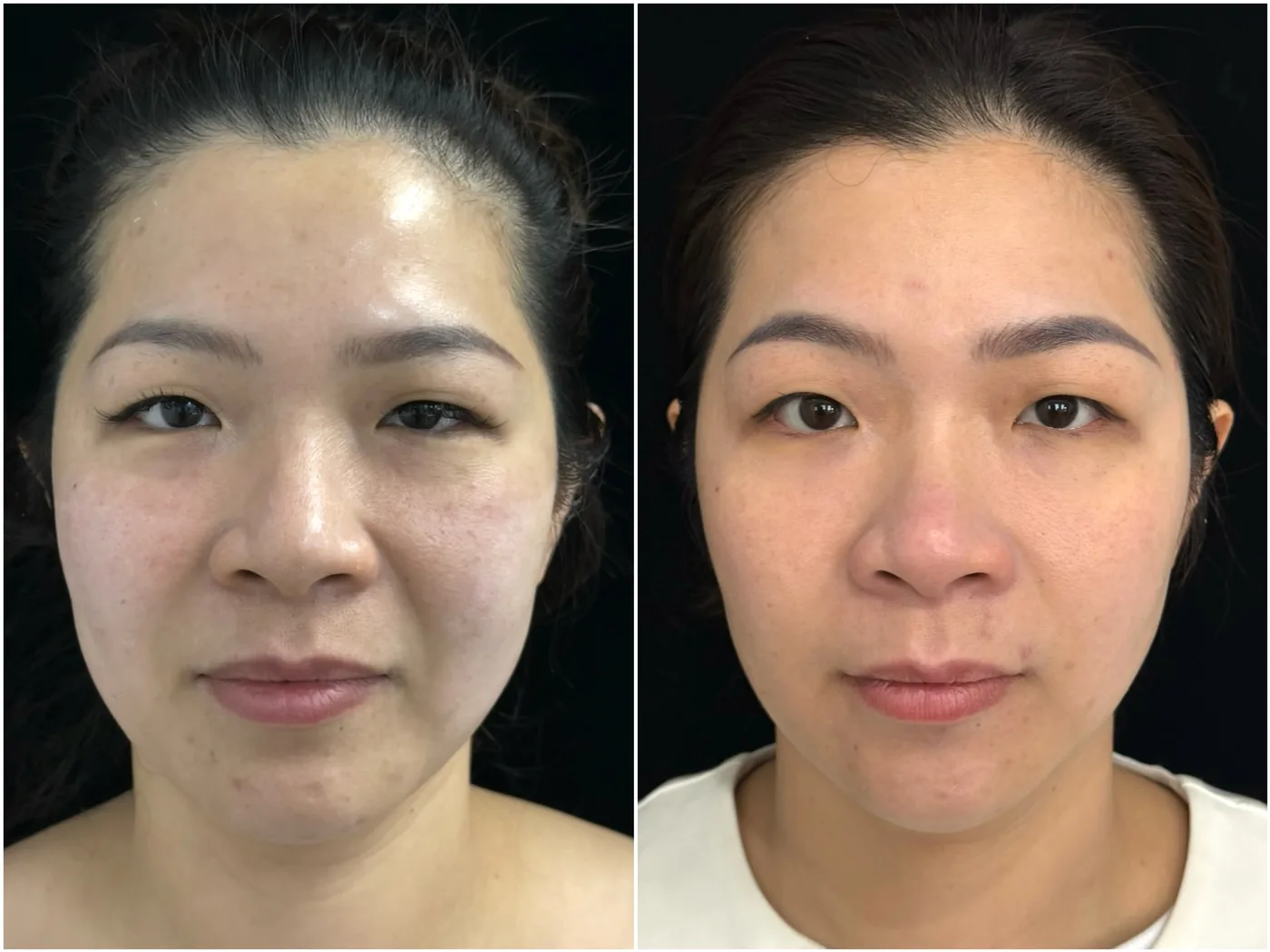 Ultherapy · Real Client Result